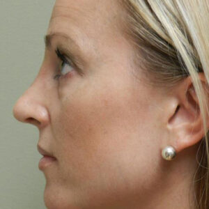 Rhinoplasty before and after photos