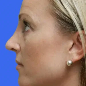 Rhinoplasty before and after photos