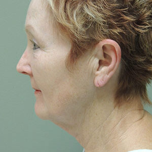 Laser Lift before and after photos