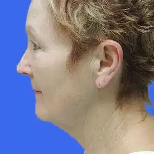 Laser Lift before and after photos