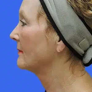 Laser Lift before and after photos