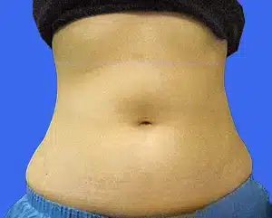 CoolSculpting before and after photos CoolSculpting before and after photos