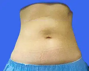 CoolSculpting before and after photos CoolSculpting before and after photos