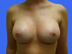 Breast Augmentation before and after photos Breast Augmentation before and after photos