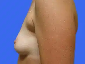 Breast Augmentation before and after photos Breast Augmentation before and after photos