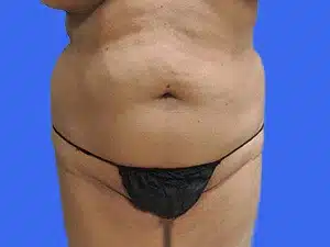 Liposuction before and after photos Liposuction before and after photos