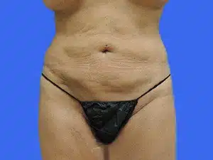 Liposuction before and after photos Liposuction before and after photos