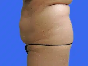 Liposuction before and after photos Liposuction before and after photos