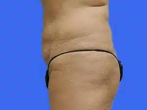 Liposuction before and after photos Liposuction before and after photos