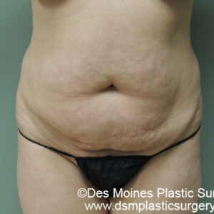 Tummy Tuck before and after photos