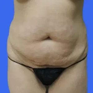 Tummy Tuck before and after photos Tummy Tuck before and after photos