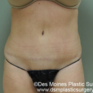 Tummy Tuck before and after photos