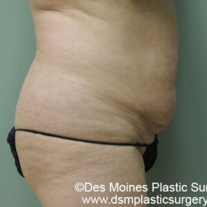 Tummy Tuck before and after photos