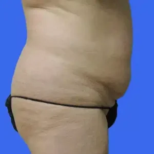 Tummy Tuck before and after photos Tummy Tuck before and after photos