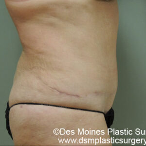 Tummy Tuck before and after photos