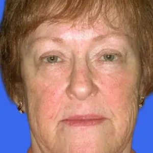 Face Lift before and after photos