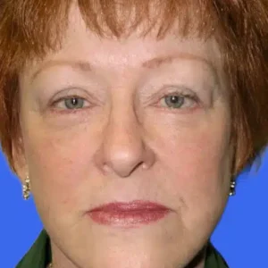 Face Lift before and after photos