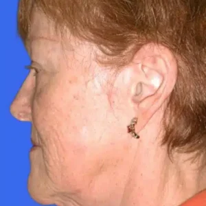 Face Lift before and after photos