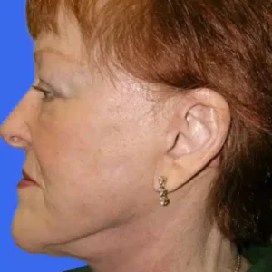 Face Lift before and after photos