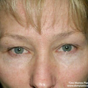 Eyelid Surgery before and after photos