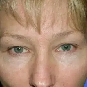 Eyelid Surgery before and after photos