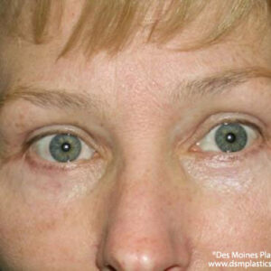 Eyelid Surgery before and after photos