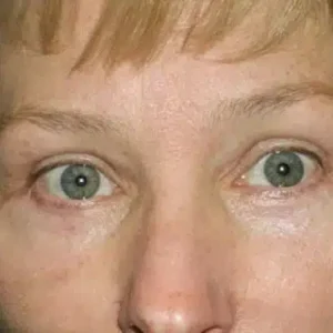 Eyelid Surgery before and after photos