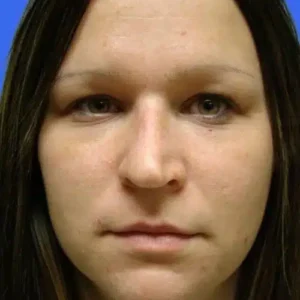 Rhinoplasty before and after photos