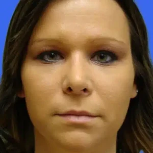 Rhinoplasty before and after photos