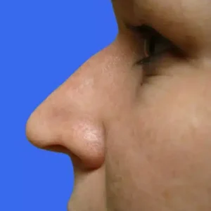 Rhinoplasty before and after photos