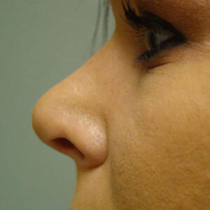 Rhinoplasty before and after photos