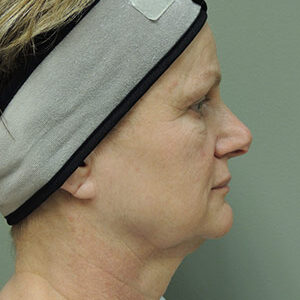 Laser Lift before and after photos