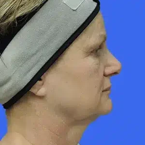 Laser Lift before and after photos