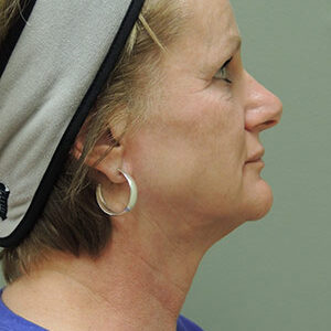 Laser Lift before and after photos