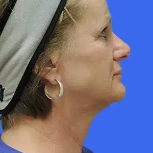 Laser Lift before and after photos