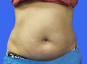 CoolSculpting before and after photos CoolSculpting before and after photos