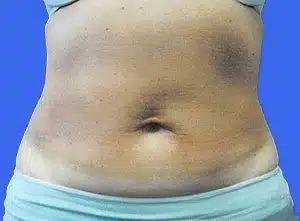 CoolSculpting before and after photos CoolSculpting before and after photos