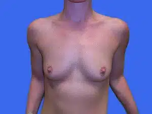 Breast Augmentation before and after photos Breast Augmentation before and after photos
