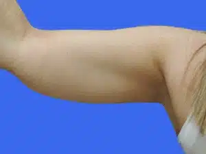 Liposuction before and after photos Liposuction before and after photos