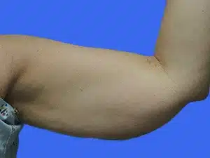 Liposuction before and after photos Liposuction before and after photos