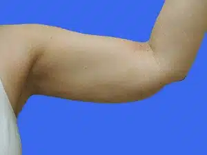 Liposuction before and after photos Liposuction before and after photos