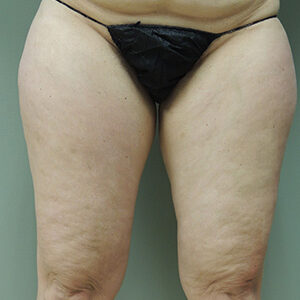 Liposuction before and after photos