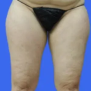 Liposuction before and after photos Liposuction before and after photos