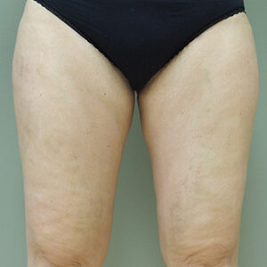 Liposuction before and after photos