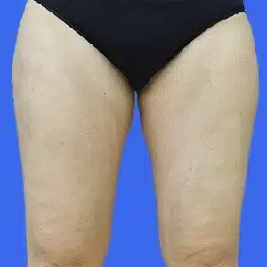 Liposuction before and after photos Liposuction before and after photos