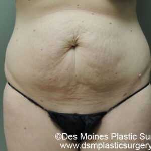 Tummy Tuck before and after photos