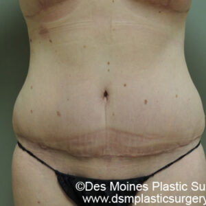 Tummy Tuck before and after photos