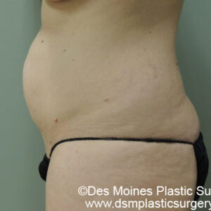 Tummy Tuck before and after photos