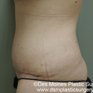 Tummy Tuck before and after photos