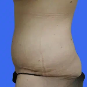 Tummy Tuck before and after photos Tummy Tuck before and after photos